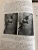 The Treatment of Fractures by Lorenz B&ouml;hler - 6