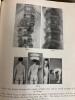 The Treatment of Fractures by Lorenz B&ouml;hler - 16